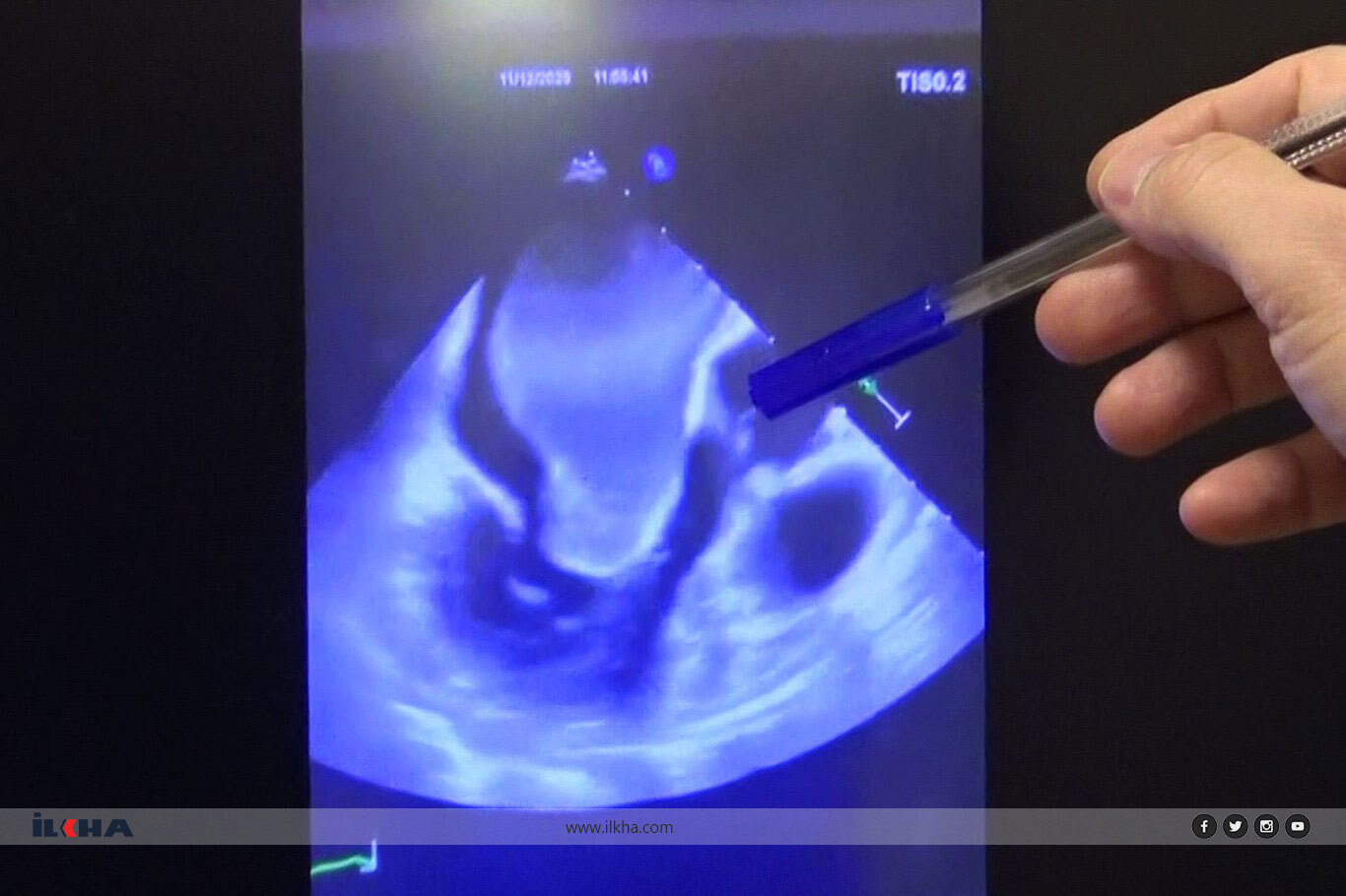 Türkiye'de bir ilk: Kalbin içini kaplayan dev kitle başarıyla çıkarıldı