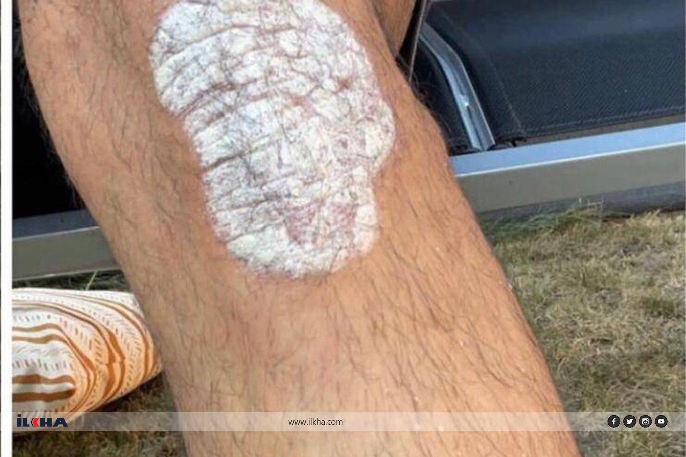 Sedef, egzama ve uyuz hastalıklarına bitkisel çözüm Sedef, egzama ve uyuz hastalıklarına bitkisel çözüm