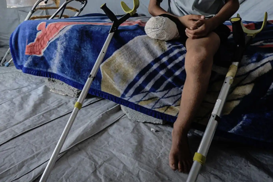 Medical officials: More than 6,000 amputations performed since start of Gaza genocide