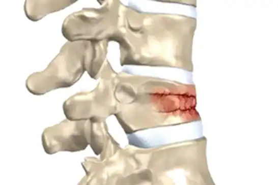 Omurga kırıkları kış aylarında artıyor