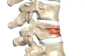 Omurga kırıkları kış aylarında artıyor