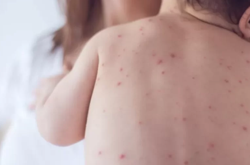 أميركا.. إصابات الحصبة في تكساس ترتفع إلى 683 حالة