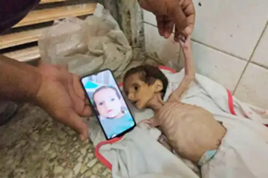 أكثر من 100 طفل يدخلون المستشفيات يوميًا في غزة بسبب سوء التغذية