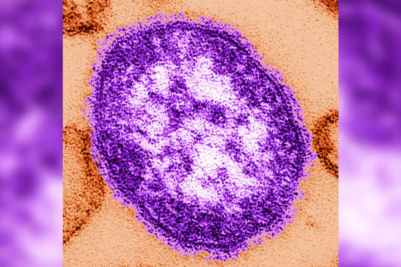 Child dies from measles in UK as health officials warn of outbreak risk Child dies from measles in UK as health officials warn of outbreak risk