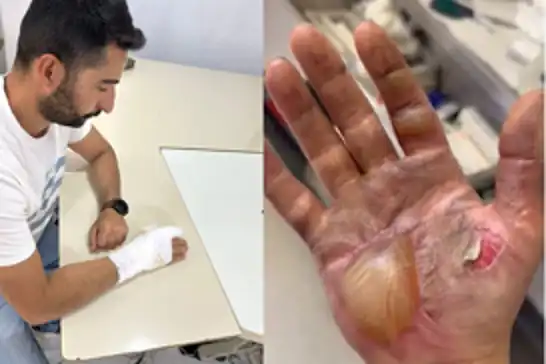 Telefon bataryası patladı tamirci yaralandı