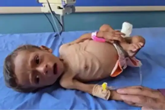 استشهاد 185 شخصاً في غزة جراء الجوع خلال شهر آب