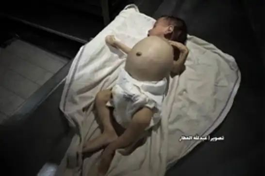 غزة..ارتفاع عدد شهداء التجويع الصهيوني إلى 399 بينهم 140 طفلًا