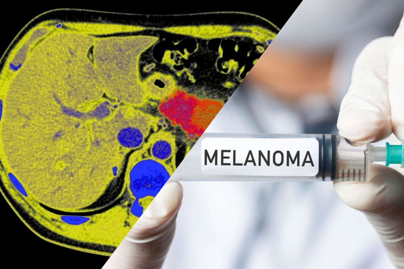 Kişiye özel kanser aşısı, melanomun tekrarlama riskini yüzde 42 azalttı