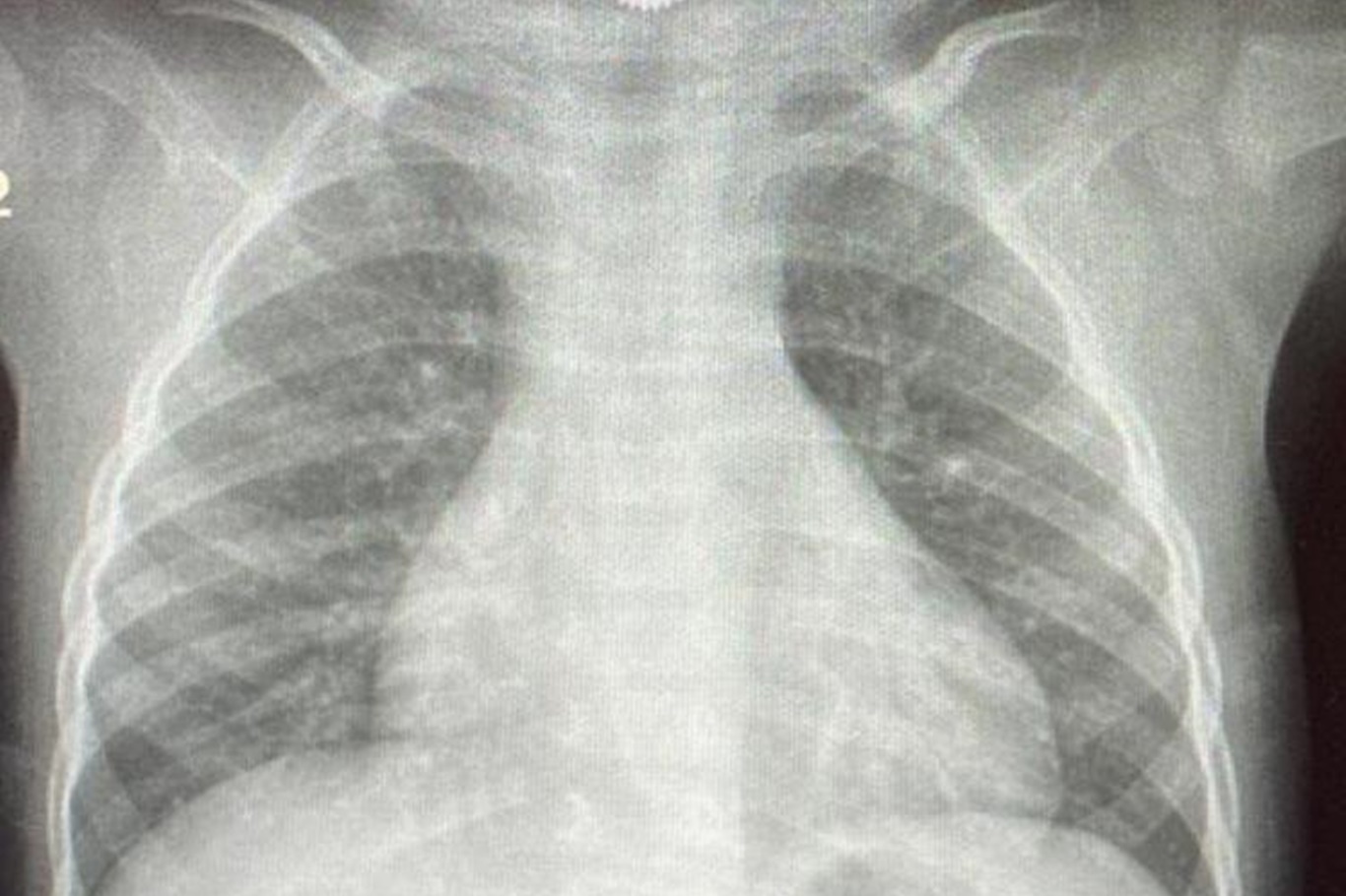 Op. Dr. Özkaya'dan çocuklarda yabancı cisim ve kimyasal madde uyarısı