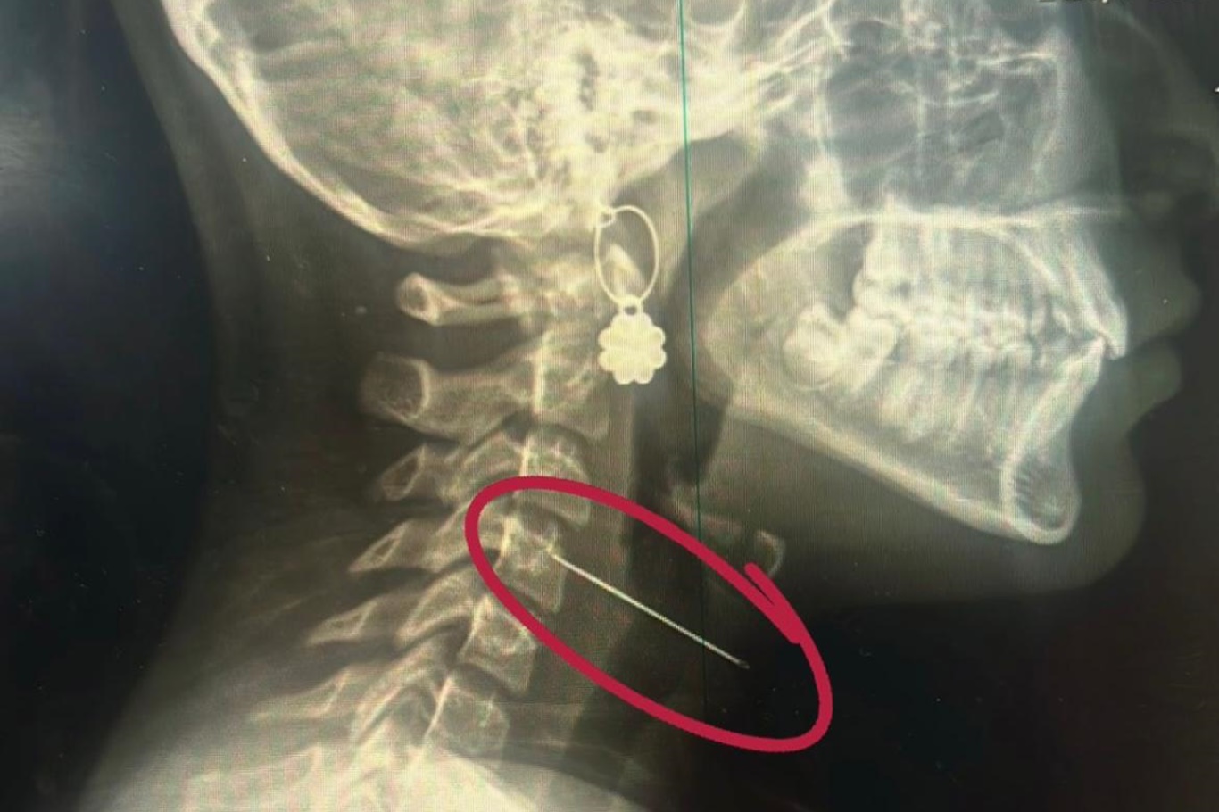 Op. Dr. Özkaya'dan çocuklarda yabancı cisim ve kimyasal madde uyarısı