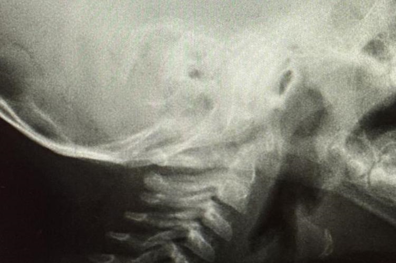 Op. Dr. Özkaya'dan çocuklarda yabancı cisim ve kimyasal madde uyarısı