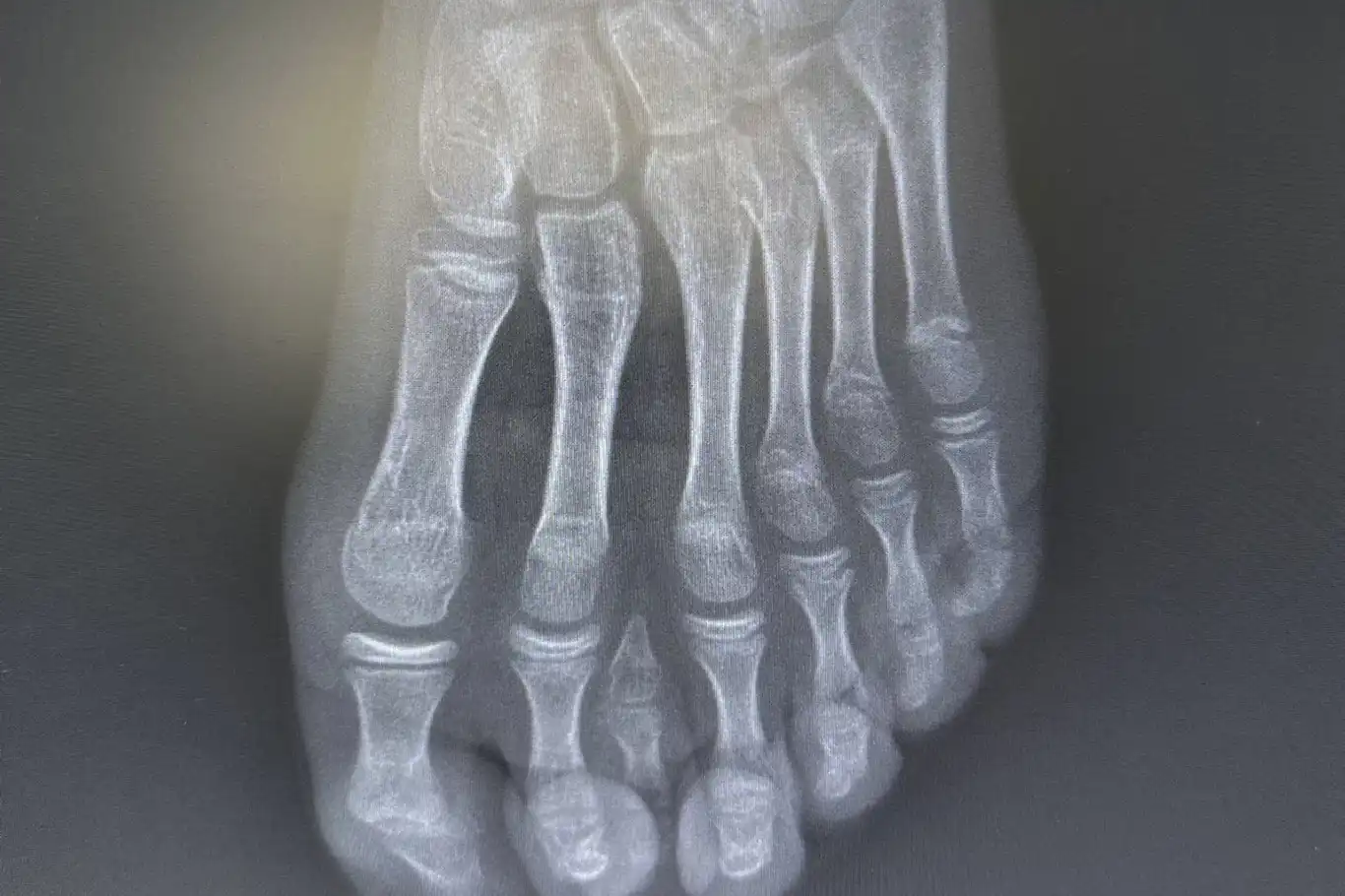 Batman'da nadir 7 parmaklı ayak vakası başarıyla tedavi edildi