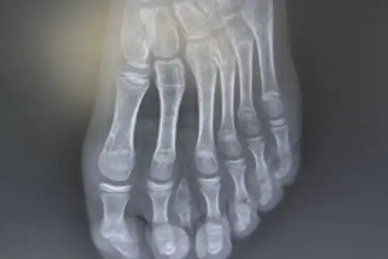 Batman'da nadir 7 parmaklı ayak vakası başarıyla tedavi edildi