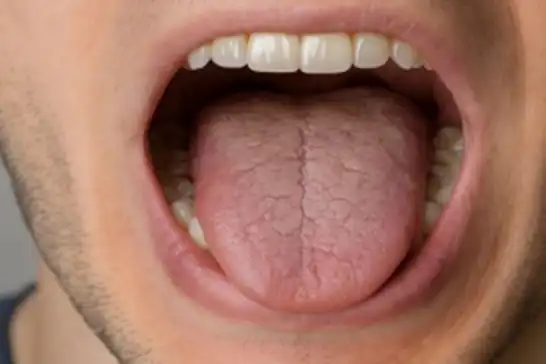 ما الذي يسبب جفاف الفم؟