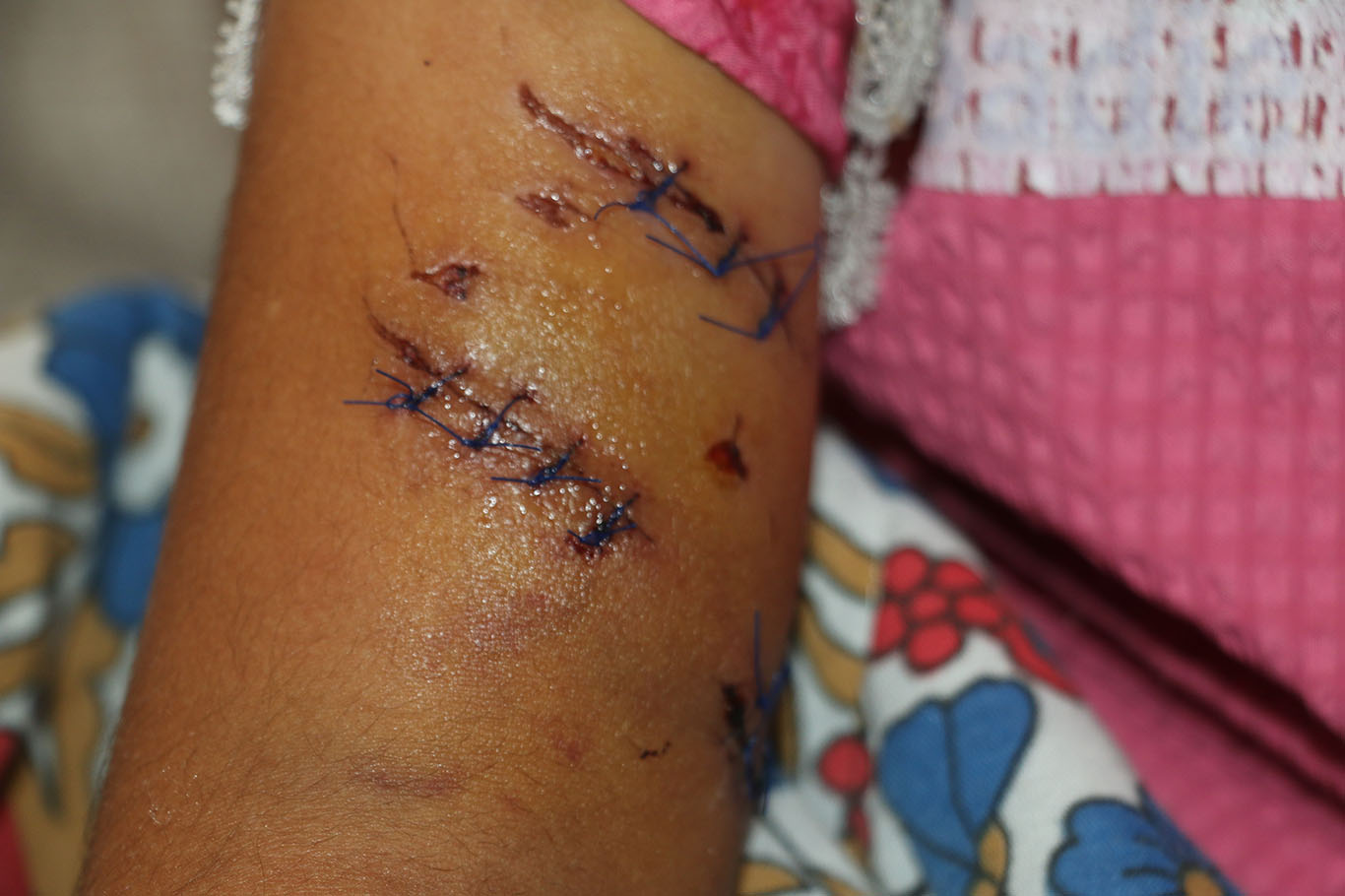 Şanlıurfa'da köpek saldırısına uğrayan Hevin için HÜDA PAR'dan yetkililere çağrı