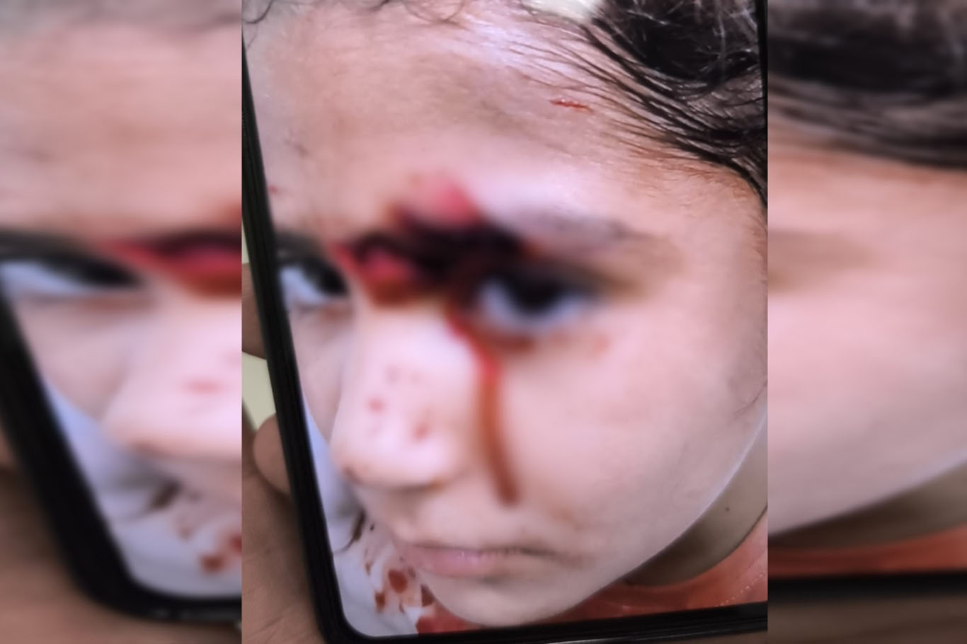Şanlıurfa'da köpek saldırısına uğrayan Hevin için HÜDA PAR'dan yetkililere çağrı